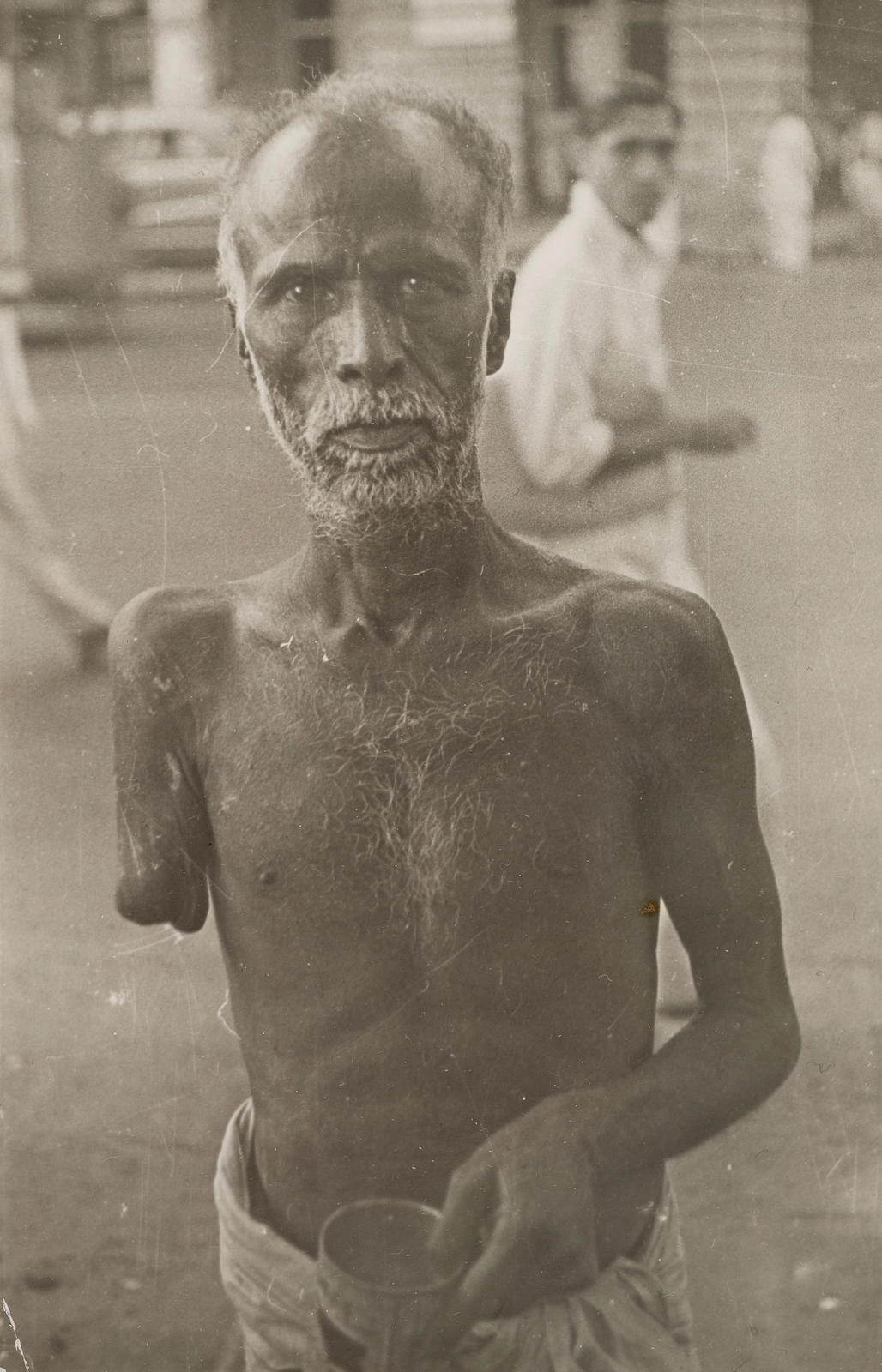 Bombay (beggar with amputated arm)